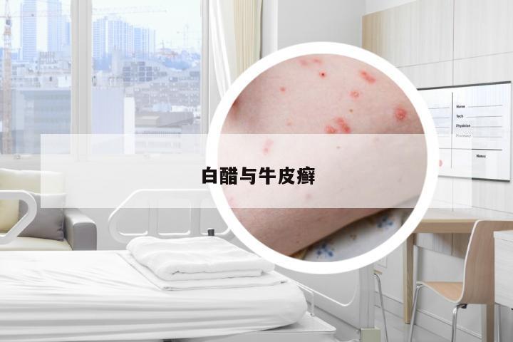 白醋与牛皮癣