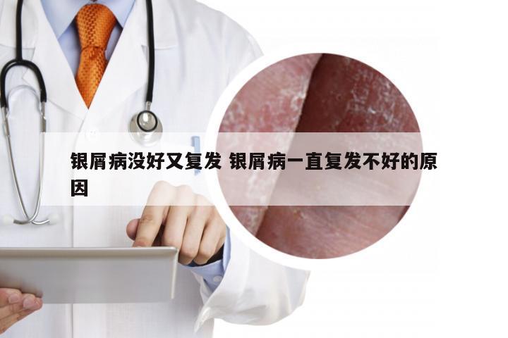 银屑病没好又复发 银屑病一直复发不好的原因