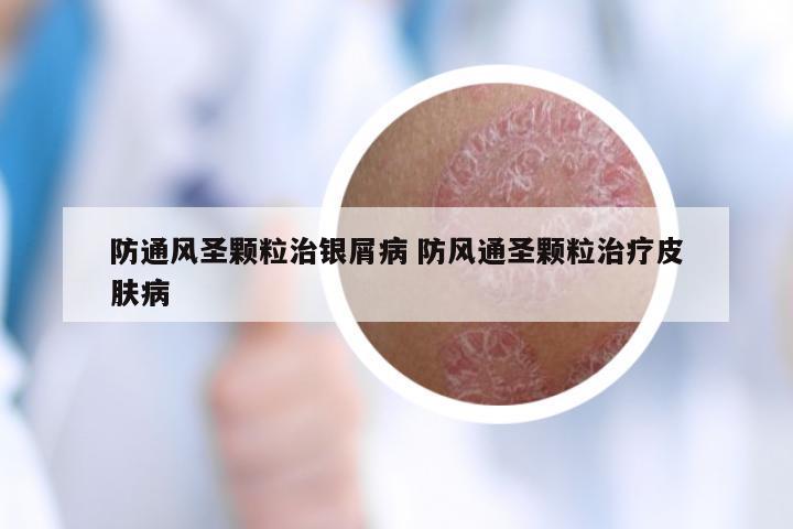 防通风圣颗粒治银屑病 防风通圣颗粒治疗皮肤病