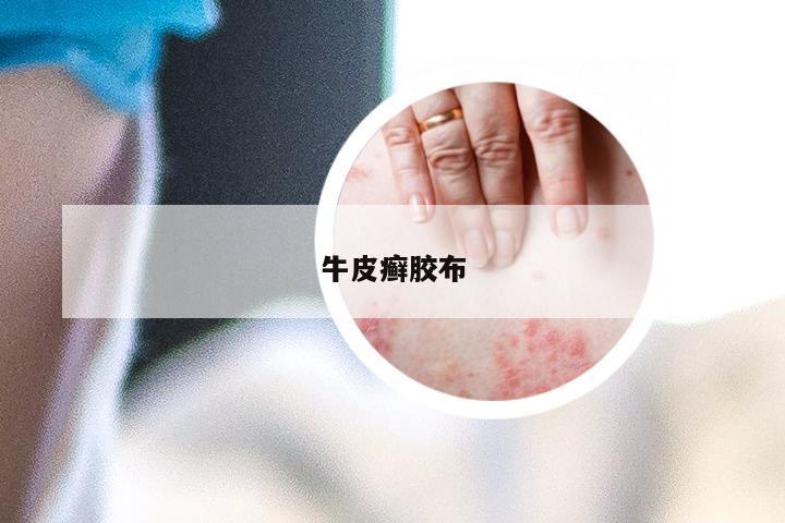 牛皮癣胶布