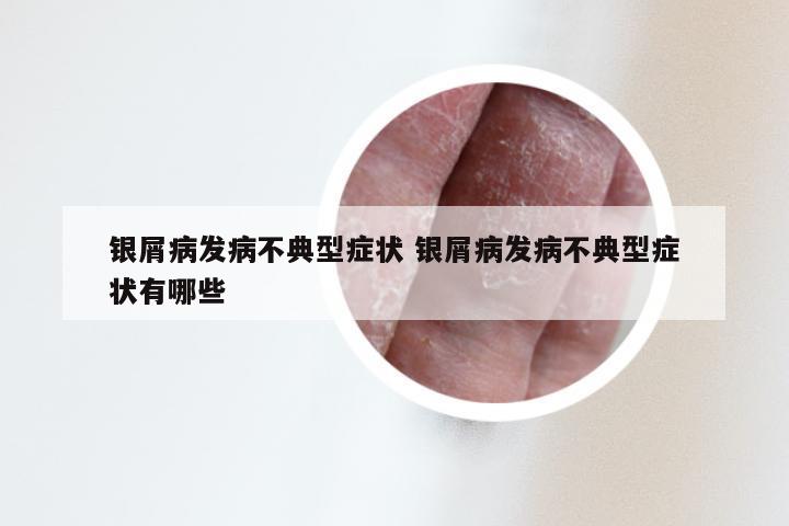 银屑病发病不典型症状 银屑病发病不典型症状有哪些