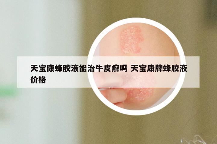 天宝康蜂胶液能治牛皮癣吗 天宝康牌蜂胶液价格