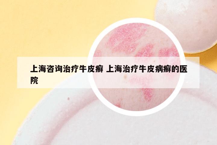 上海咨询治疗牛皮癣 上海治疗牛皮病癣的医院