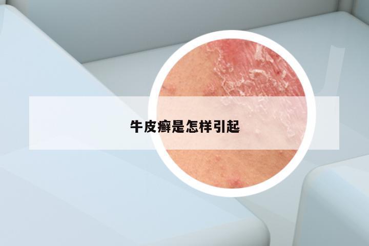牛皮癣是怎样引起