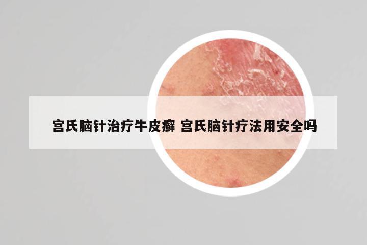 宫氏脑针治疗牛皮癣 宫氏脑针疗法用安全吗