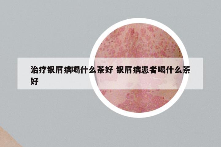 治疗银屑病喝什么茶好 银屑病患者喝什么茶好