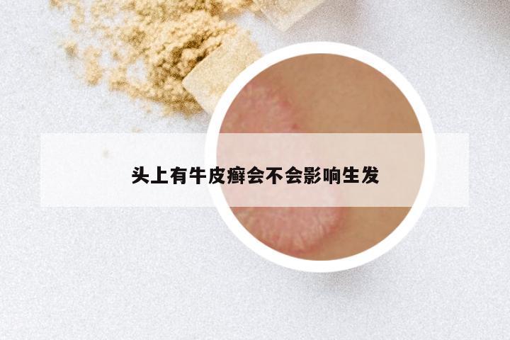 头上有牛皮癣会不会影响生发