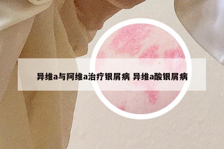 异维a与阿维a治疗银屑病 异维a酸银屑病