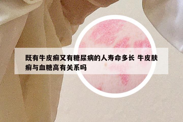 既有牛皮癣又有糖尿病的人寿命多长 牛皮肤癣与血糖高有关系吗