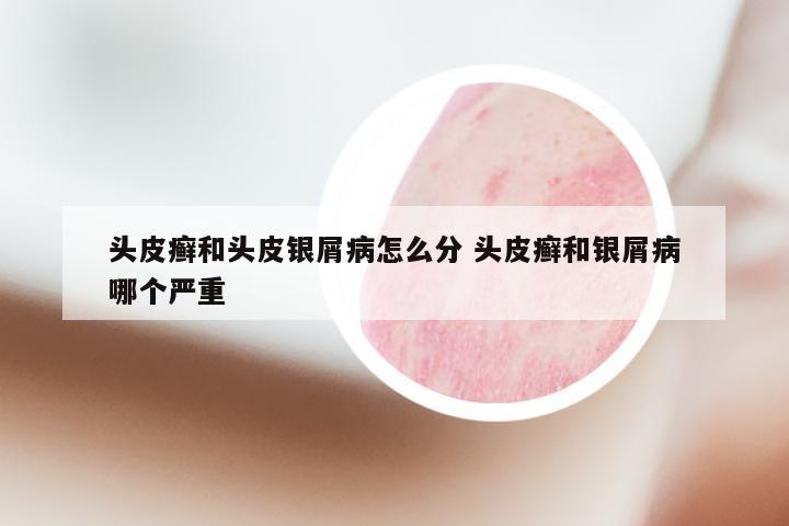 头皮癣和头皮银屑病怎么分 头皮癣和银屑病哪个严重