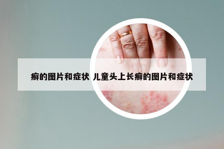 癣的图片和症状 儿童头上长癣的图片和症状