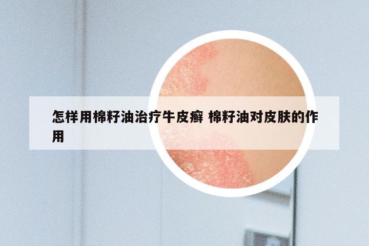 怎样用棉籽油治疗牛皮癣 棉籽油对皮肤的作用