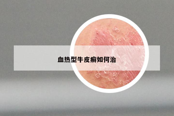 血热型牛皮癣如何治