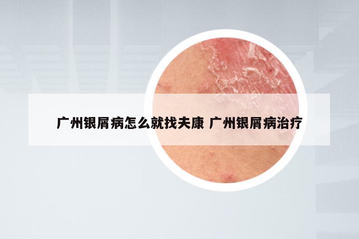 广州银屑病怎么就找夫康 广州银屑病治疗