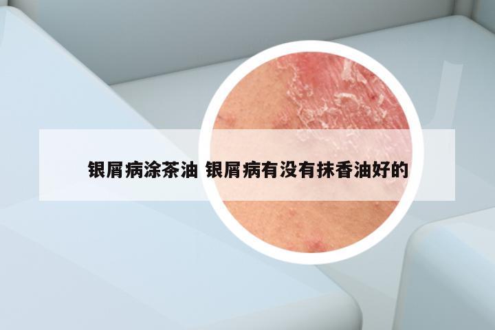 银屑病涂茶油 银屑病有没有抹香油好的
