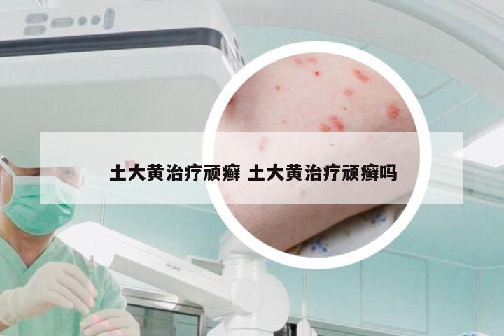 土大黄治疗顽癣 土大黄治疗顽癣吗