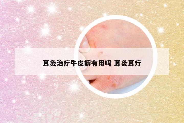 耳灸治疗牛皮癣有用吗 耳灸耳疗