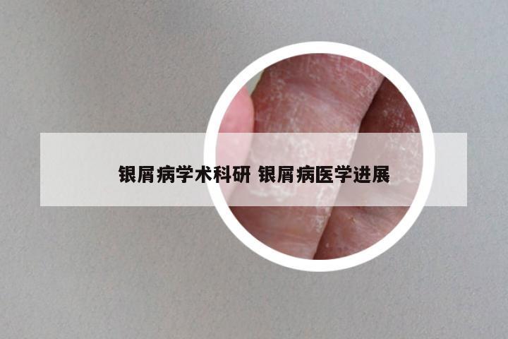 银屑病学术科研 银屑病医学进展