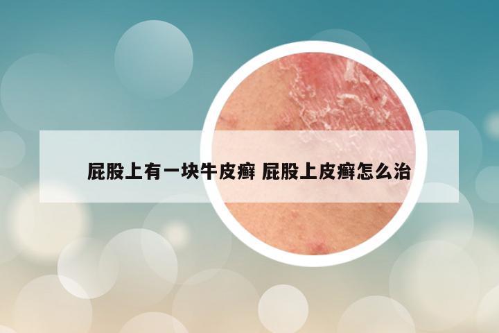 屁股上有一块牛皮癣 屁股上皮癣怎么治