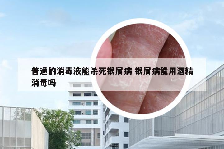 普通的消毒液能杀死银屑病 银屑病能用酒精消毒吗