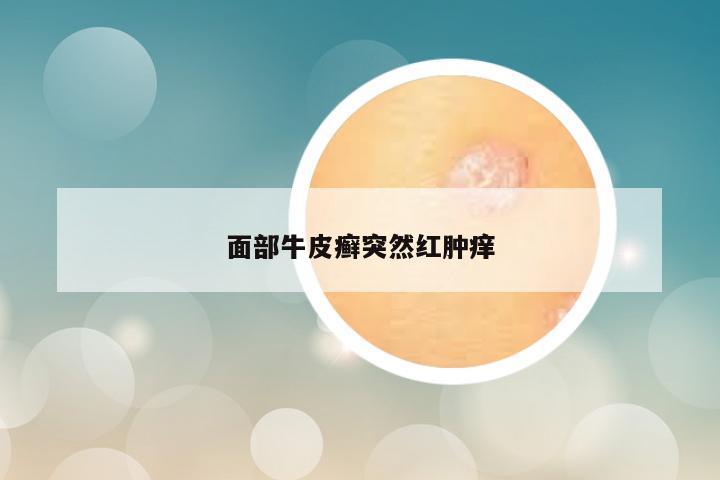 面部牛皮癣突然红肿痒