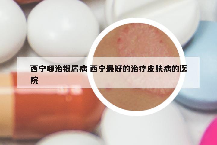 西宁哪治银屑病 西宁最好的治疗皮肤病的医院