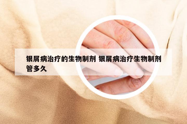 银屑病治疗的生物制剂 银屑病治疗生物制剂管多久
