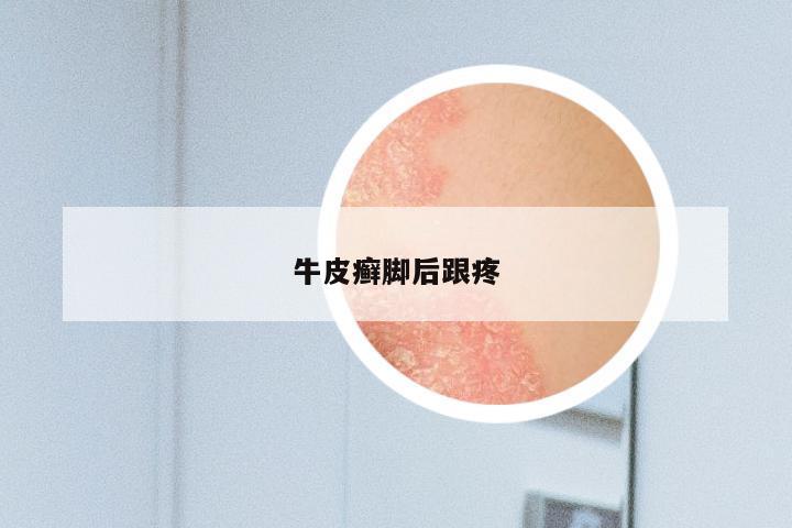 牛皮癣脚后跟疼