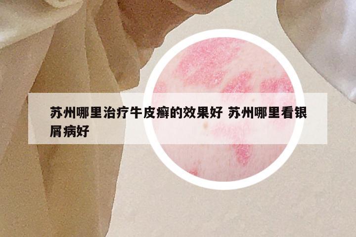 苏州哪里治疗牛皮癣的效果好 苏州哪里看银屑病好