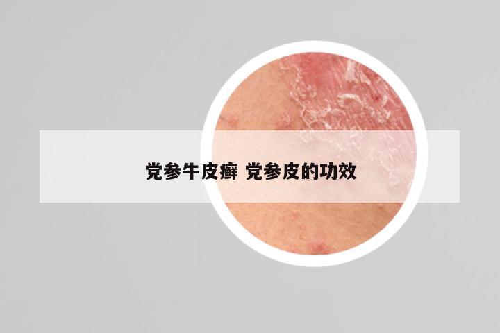党参牛皮癣 党参皮的功效