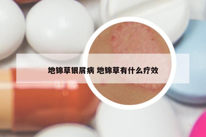地锦草银屑病 地锦草有什么疗效