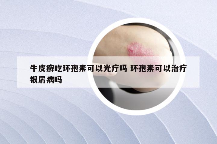 牛皮癣吃环孢素可以光疗吗 环孢素可以治疗银屑病吗