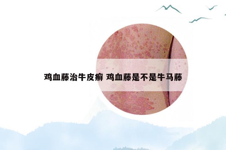 鸡血藤治牛皮癣 鸡血藤是不是牛马藤