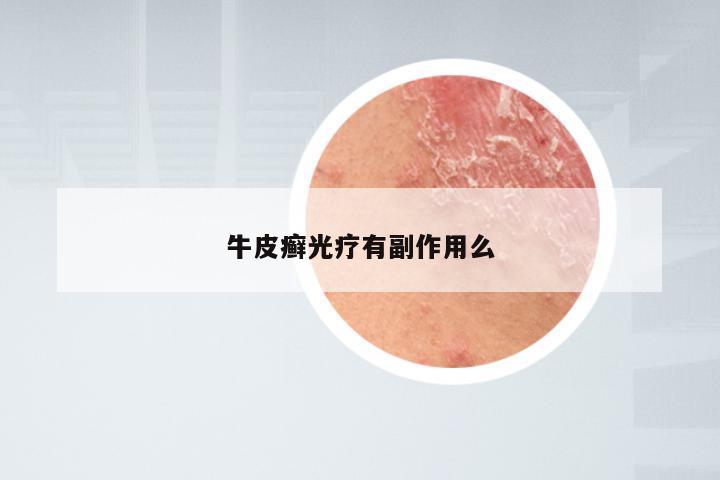 牛皮癣光疗有副作用么