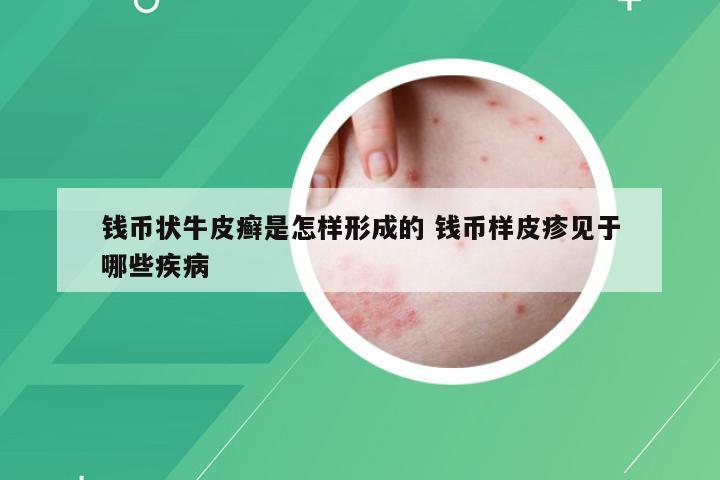 钱币状牛皮癣是怎样形成的 钱币样皮疹见于哪些疾病
