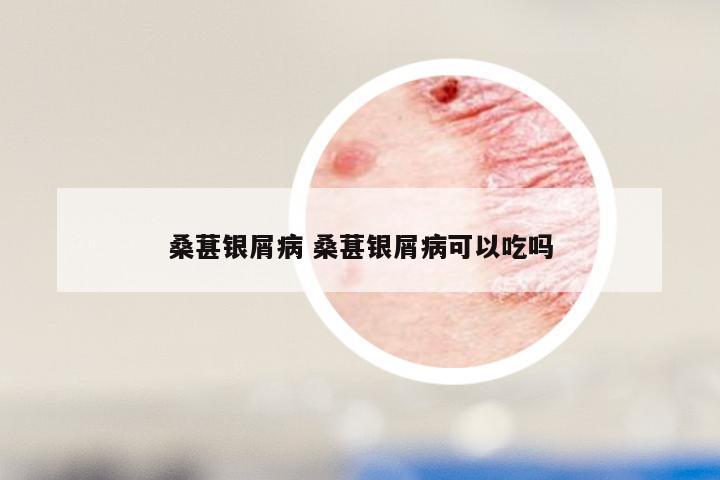 桑葚银屑病 桑葚银屑病可以吃吗