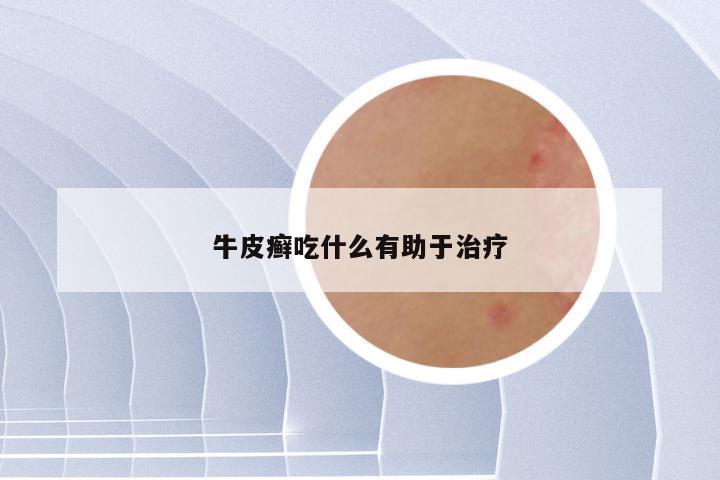 牛皮癣吃什么有助于治疗