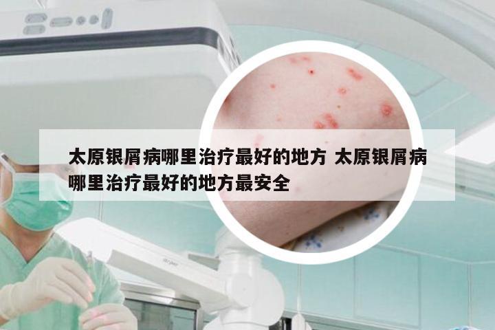 太原银屑病哪里治疗最好的地方 太原银屑病哪里治疗最好的地方最安全