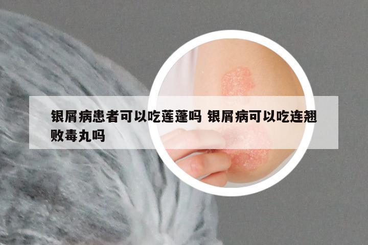 银屑病患者可以吃莲蓬吗 银屑病可以吃连翘败毒丸吗