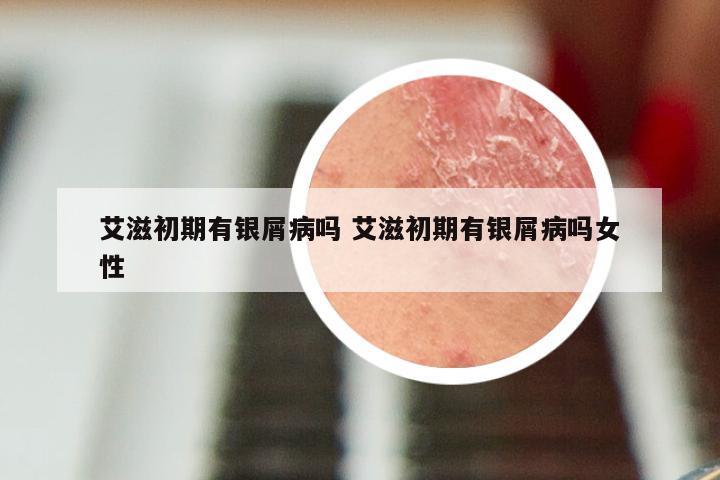 艾滋初期有银屑病吗 艾滋初期有银屑病吗女性