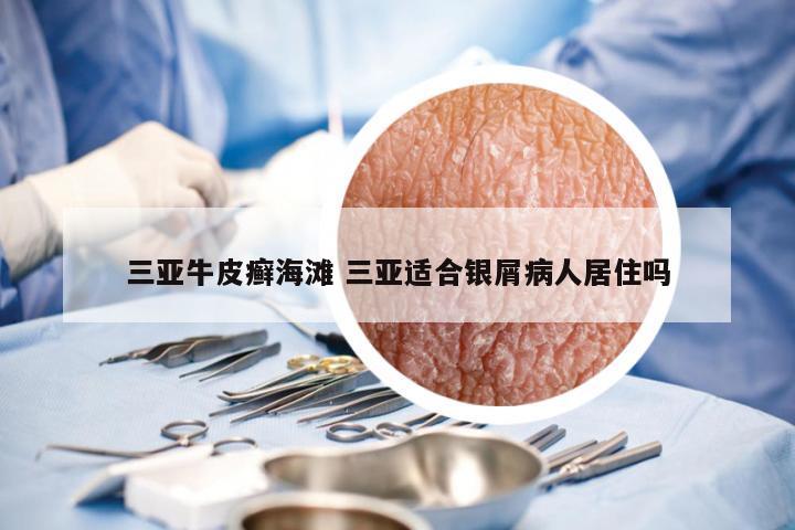 三亚牛皮癣海滩 三亚适合银屑病人居住吗