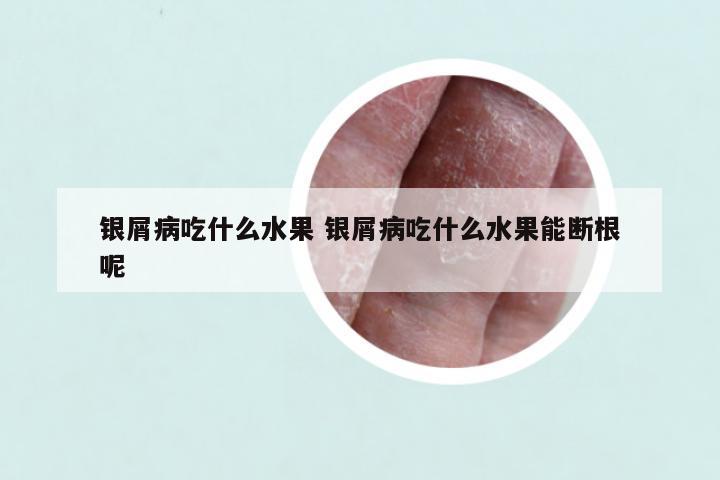 银屑病吃什么水果 银屑病吃什么水果能断根呢