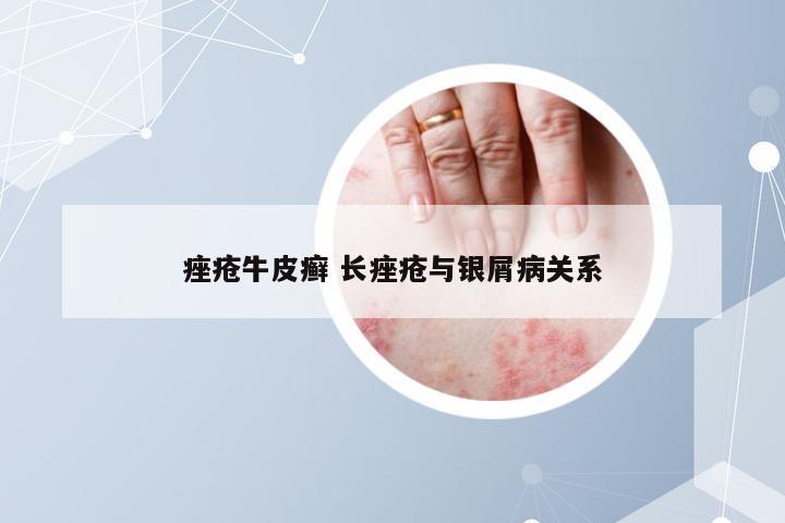 痤疮牛皮癣 长痤疮与银屑病关系