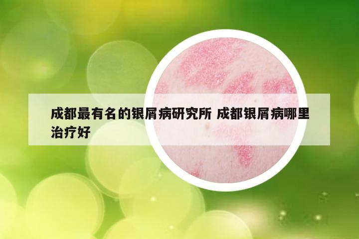 成都最有名的银屑病研究所 成都银屑病哪里治疗好