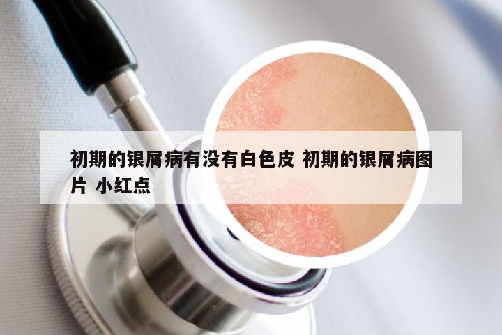 初期的银屑病有没有白色皮 初期的银屑病图片 小红点