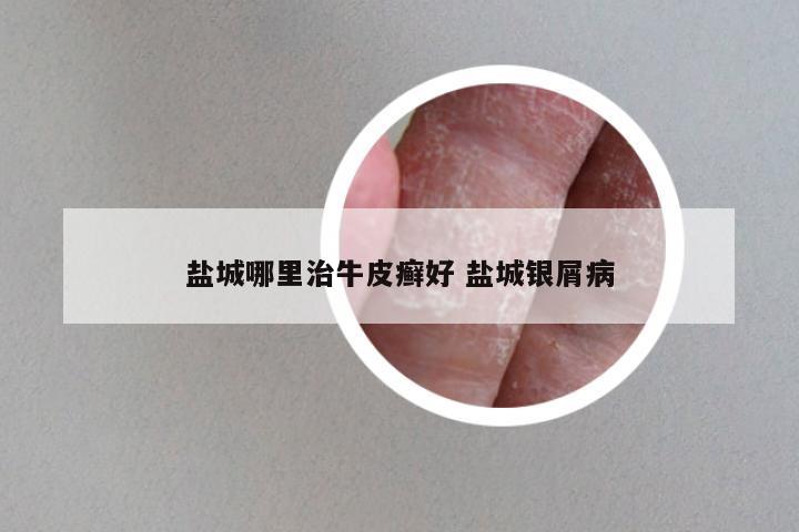 盐城哪里治牛皮癣好 盐城银屑病