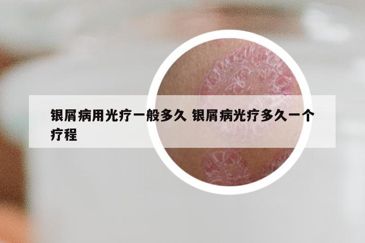 银屑病用光疗一般多久 银屑病光疗多久一个疗程