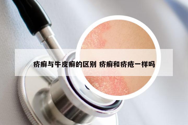 疥癣与牛皮癣的区别 疥癣和疥疮一样吗