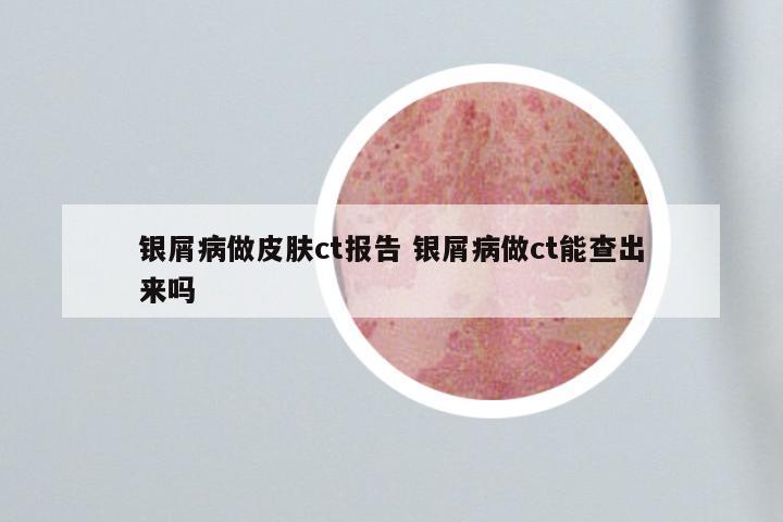 银屑病做皮肤ct报告 银屑病做ct能查出来吗