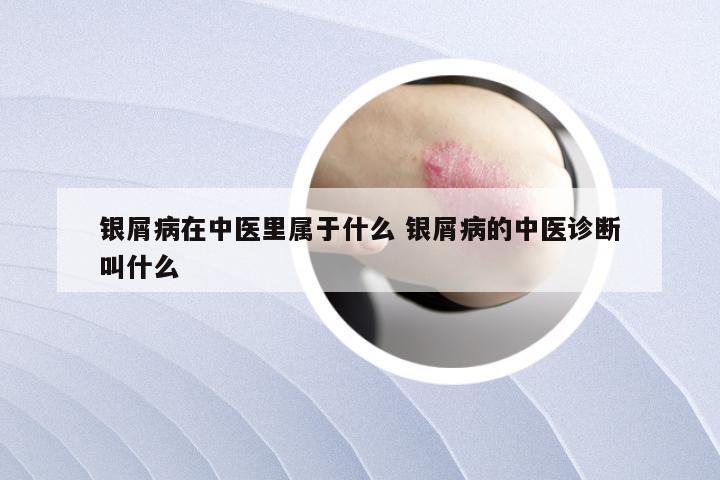 银屑病在中医里属于什么 银屑病的中医诊断叫什么